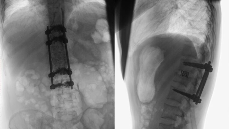 Hardware Failure in Spine Surgery: Addressing Potential Implant Issues